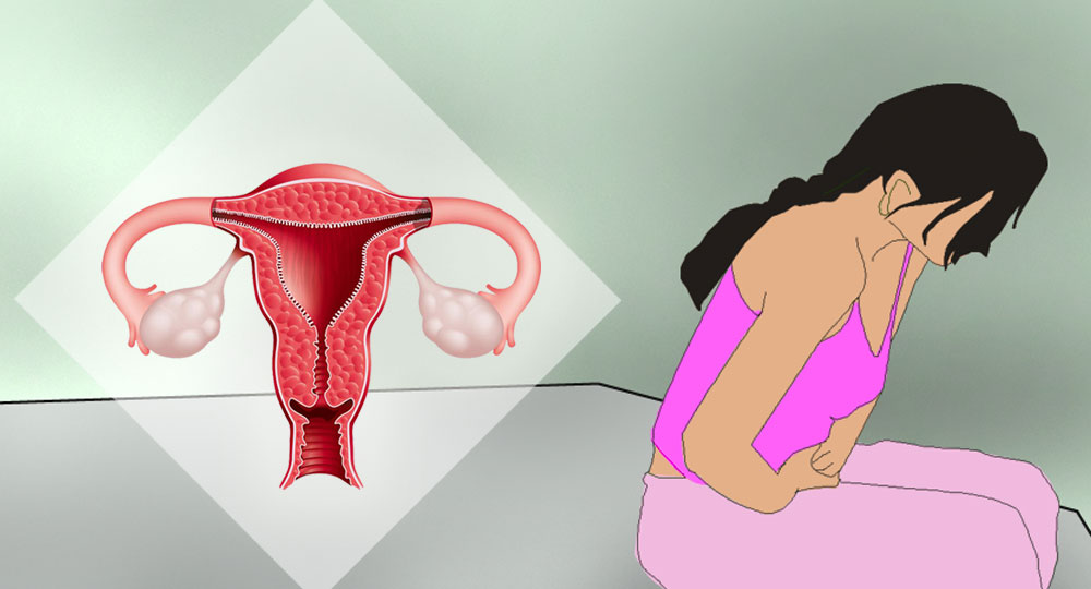 90% of women with endometrial cancer experience irregular bleeding