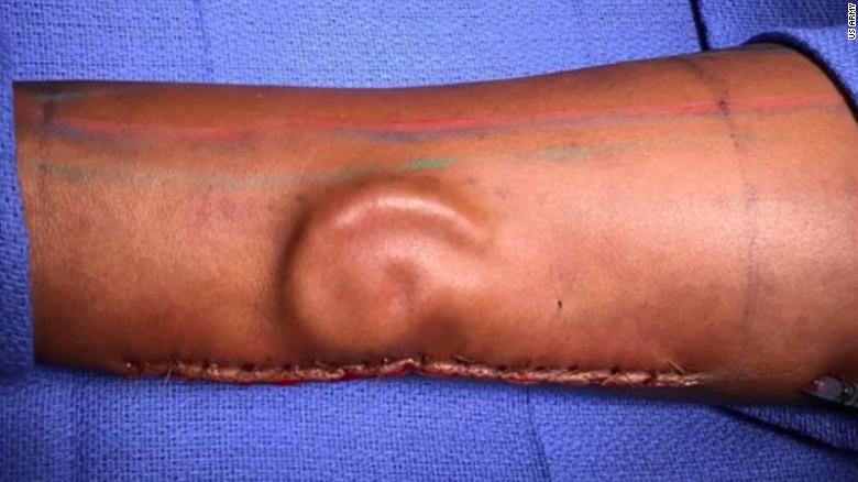 In a first, doctors in Texas re-grown soldier’s ear on forearm