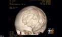 3D printed skull gives new life to seven-year-old