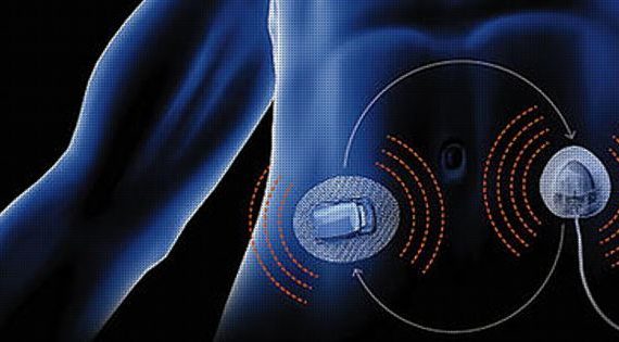 The artificial pancreas is here