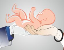 C-section controversy: Doctors term Maneka Gandhi’s demand to display caesarean rates ‘unfair’ C-section controversy: Doctors term Maneka Gandhi’s demand to display caesarean rates ‘unfair’
