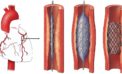 First made in India dissolvable stents approved by government