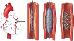 First made in India dissolvable stents approved by government First made in India dissolvable stents approved by government
