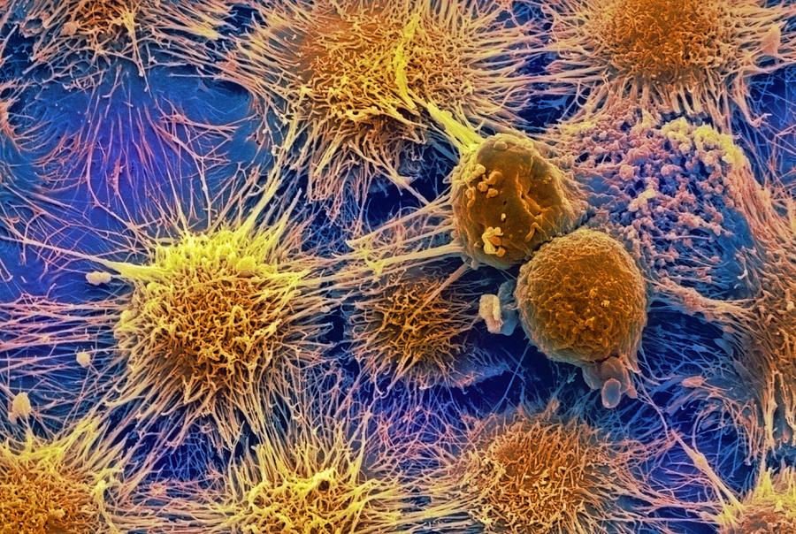 Scientist develop method to stop cancer cells from metastasizing