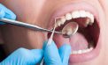 Severe gum disease could lead to pancreatic cancer 